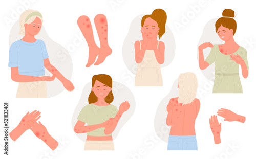 Allergy on body skin set, medical infographic flat vector illustration. Cartoon sick girl patient with allergic symptoms of itch, inflammation, irritation red spots. Dermatology, skincare concept