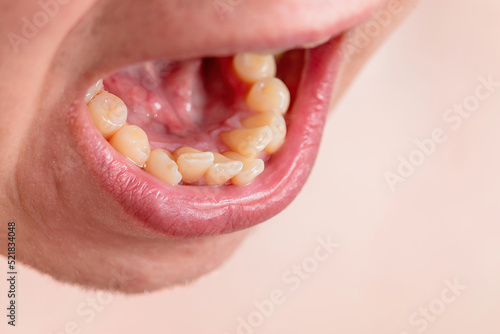 European male open mouth crooked yellow teeth dry lips
