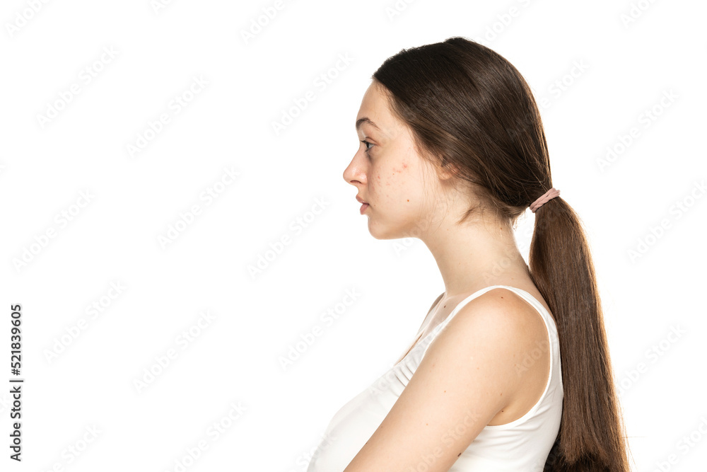 Profile view of a beautiful young women with problematic skin Profile view of a beautiful young women with problematic skin