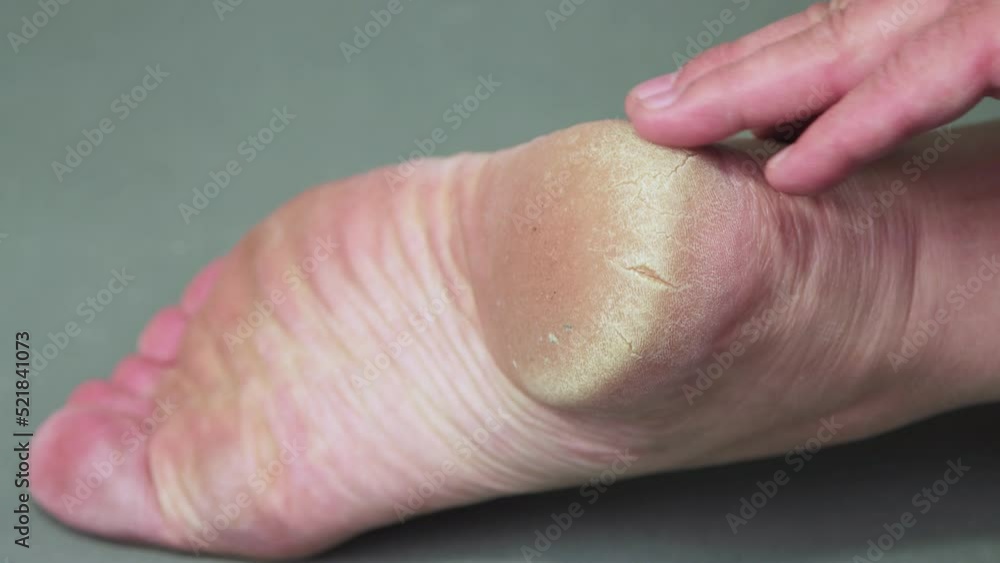 A hand rubs the keratinized skin of the heel of a man's foot. Keratinization and thickening of the epidermis in the sole of the foot. Foot care concept. Isolated video, close-up. UHD 4K. A hand rubs the keratinized skin of the heel of a man's foot. Keratinization and thickening of the epidermis in the sole of the foot. Foot care concept. Isolated video, close-up. UHD 4K.