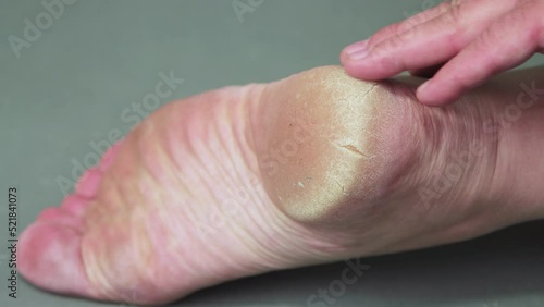 A hand rubs the keratinized skin of the heel of a man's foot. Keratinization and thickening of the epidermis in the sole of the foot. Foot care concept. Isolated video, close-up. UHD 4K.
