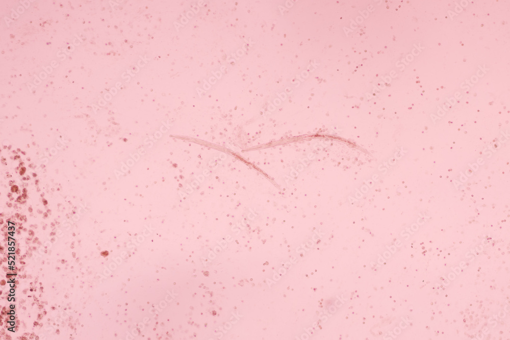 View in microscopic Strongyloides stercoralis or threadworm in human