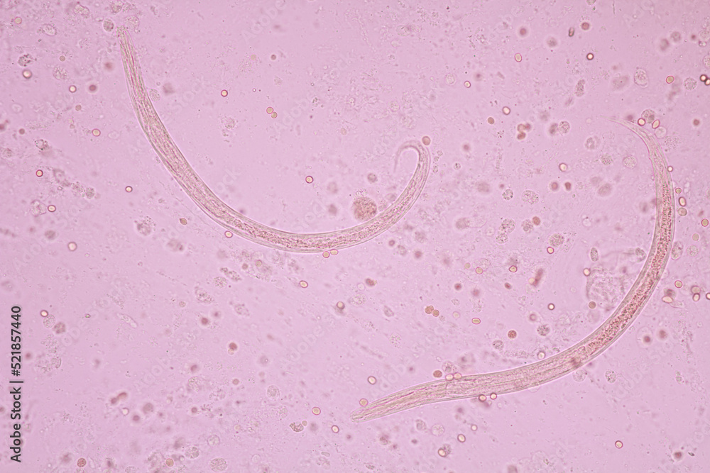 View in microscopic Strongyloides stercoralis or threadworm in human