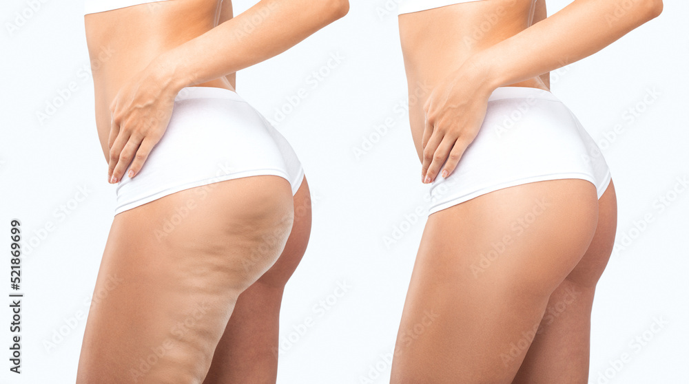 Fat woman with cellulite on her legs. Obese woman in white