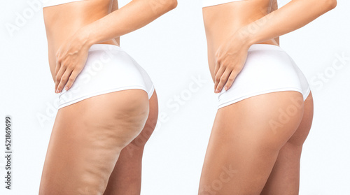 Fat woman with cellulite on her legs. Obese woman in white underwear.Overweight treatment.Photos in comparison before and after the treatment of overweight and cellulite.