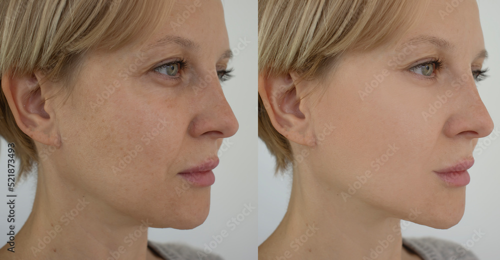 Fototapeta premium Woman face wrinkles before and after treatment