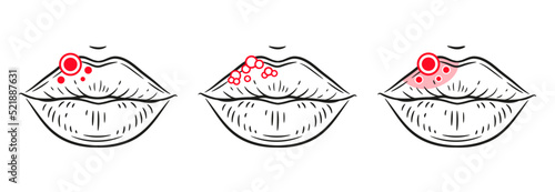 Herpes virus rash on lips, labial sore, inflammation skin face, stomatitis mouth line icon. Blister, ulcer, red acne, facial allergy reaction. Oral infection disease medical treatment. Skincare vector