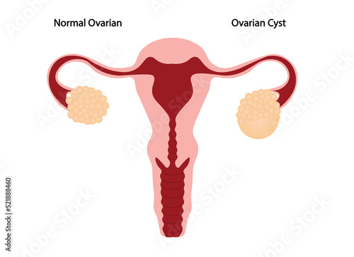 Ovarian Cyst anatomy illustration. Uterus with a cyst in the left ovarian 