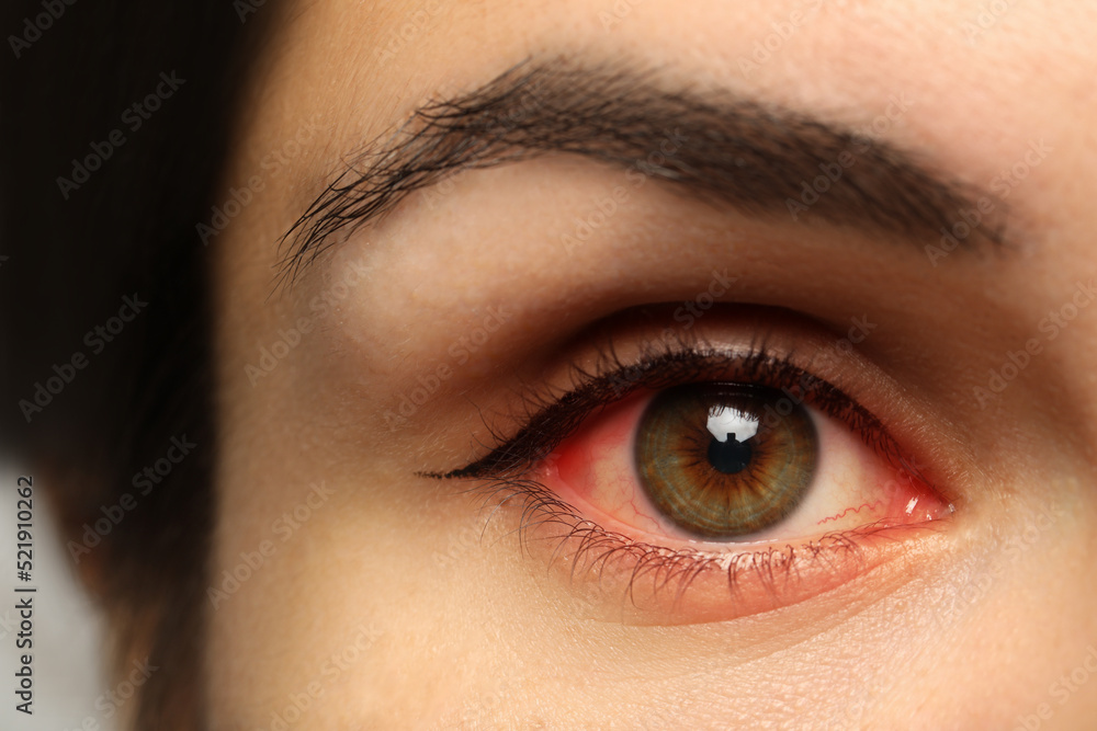 Obraz premium Closeup view of woman with inflamed eyes