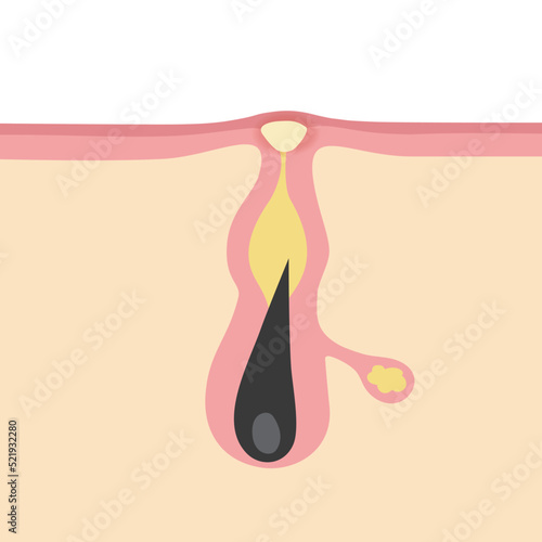 白ニキビのイメージイラスト