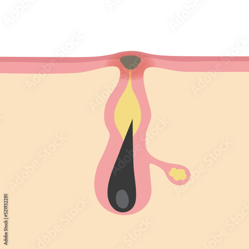 黒ニキビのイメージ