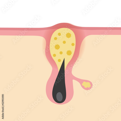 黄ニキビのイメージイラスト