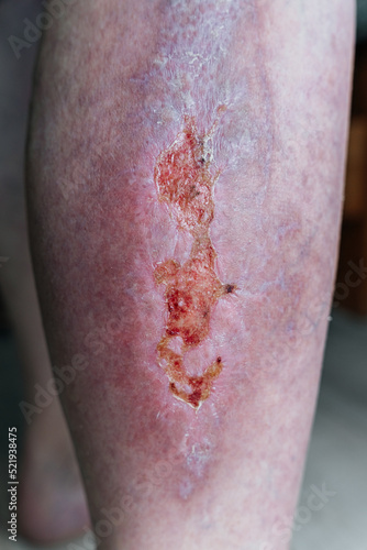 Large healing wound on the lower leg with scars, redness, scarring of the skin, the concept of human tissue regeneration.