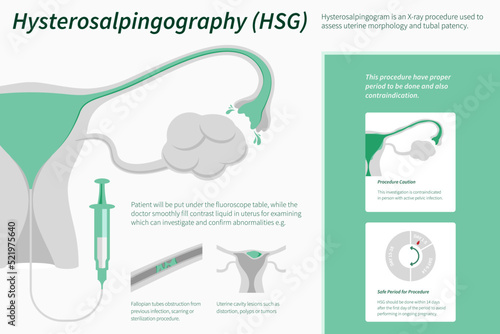 Hysterosalpingography horizontal infographic illustration about infertine healthcare and medical science vector.