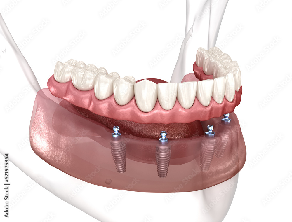 Removable prosthesis All on 4 system supported by implants. Medically accurate 3D illustration