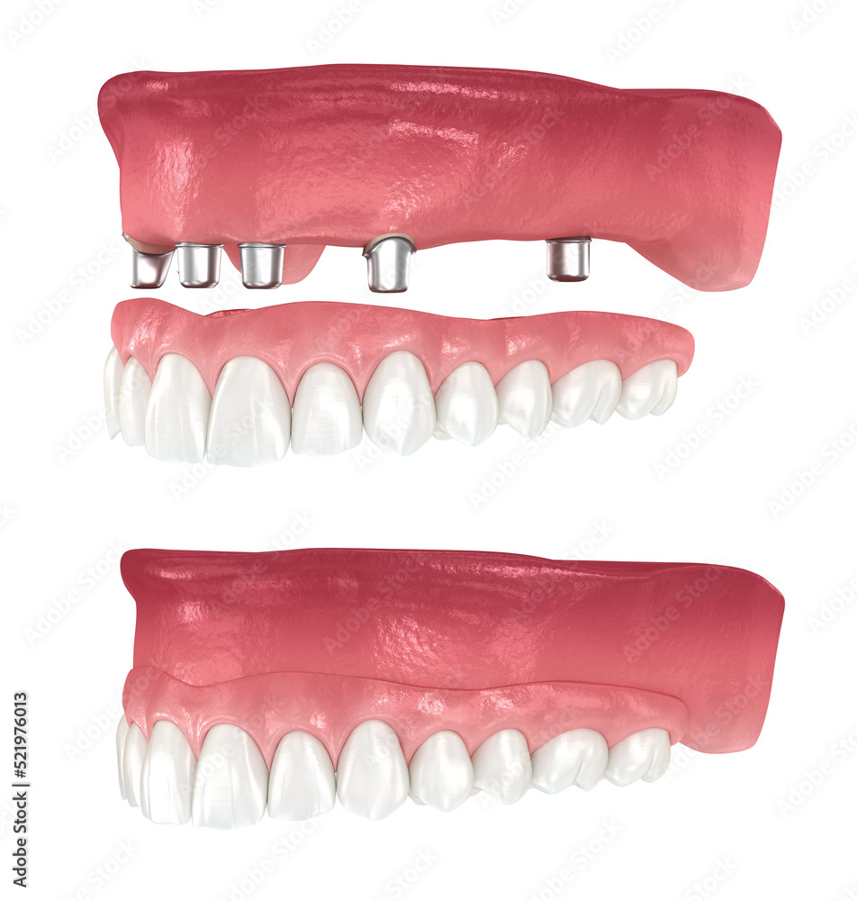 Maxillary Prosthesis Maxillary prosthesis supported by 2 teeth and 4 implants. Dental 3D ...