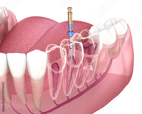 Endodontic root canal treatment process. Medically accurate tooth 3D illustration. photo