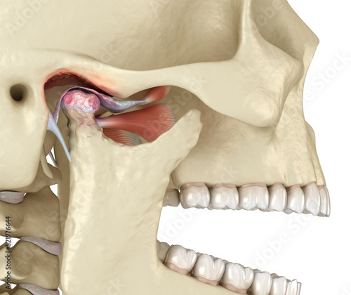 Temporomandibular joints arthritis and dislocated articular disc. Medically accurate 3D illustration. photo