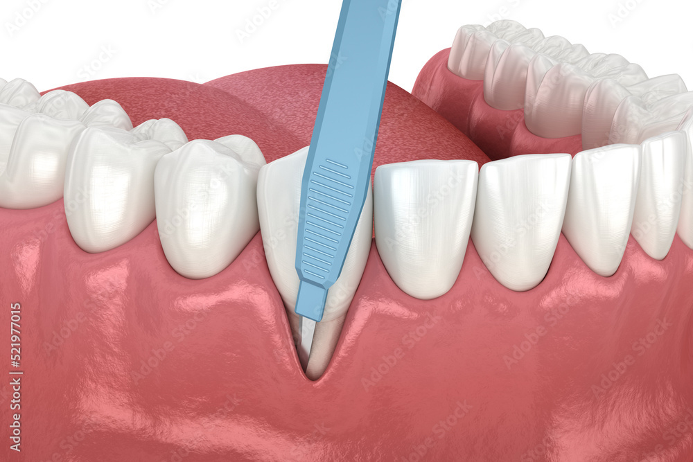 Gum Recession: Soft tissue graft surgery. 3D illustration of Dental  treatment