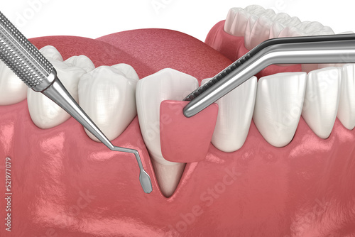 Gum Recession: Soft tissue graft surgery. 3D illustration of Dental  treatment