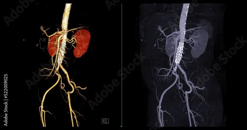 CTA abdominal Aorta for diagnostic abdominal aortic aneurysm or AAA.  photo