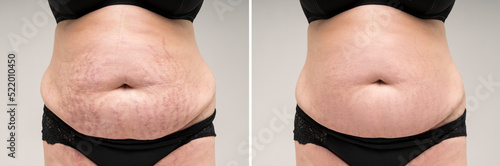 Before and after removing stretch marks from the skin, fat flabby female belly on gray background