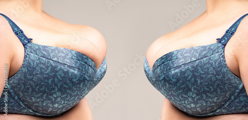 Before and after breast augmentation concept, woman with large silicone breasts after correction surgery photo