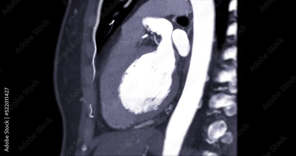 CTA Coronary artery or Cardiac CT for diagnosis coronary artery