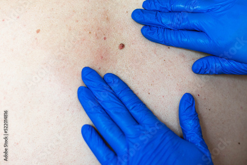 a doctor in blue gloves examines a large birthmark and birth defects. concept of clean skin