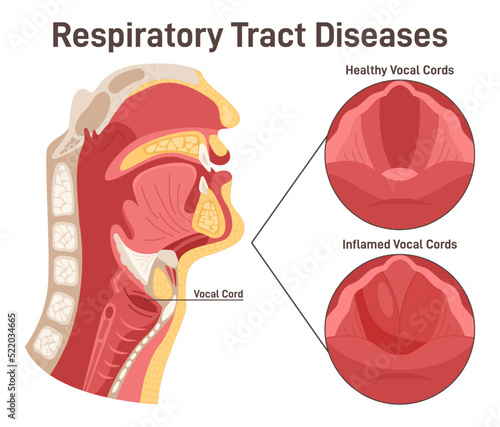 Upper respiratory tract disease. Laryngitis, inflammation of the vocal