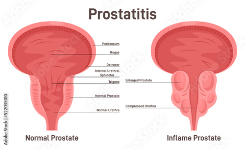 Prostatitis. Pathological disruption of male gland with enlarged