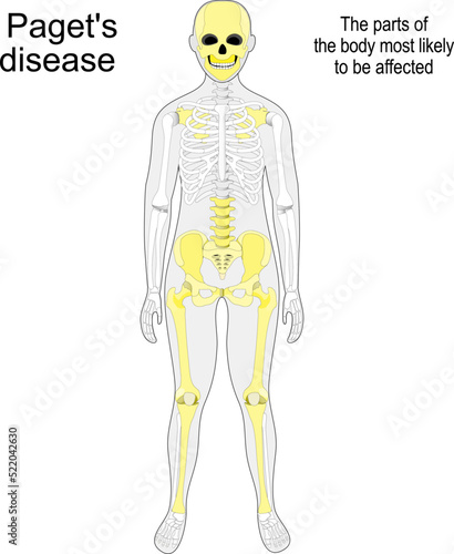 paget's disease. Skeleton and bones. osteitis deformans