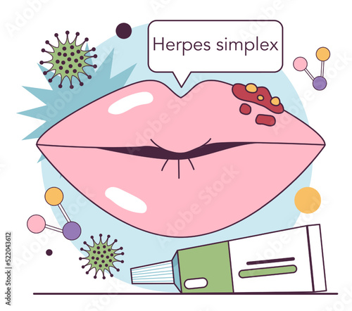 Herpes simplex virus. Herpes on the human lips. Dermatological