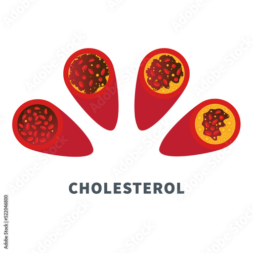 Cholesterol level on blocked blood vessel medical diagram. Atherosclerosis risk scale. Meter gauge of ldl and hdl lipoprotein. High and low fat test indicator. Healthcare concept. Vector illustration.