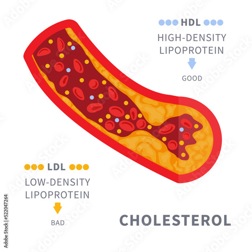 Narrowed blood vessel with cholesterol plaque buildup. Artery blocked with a fat cells clot. ldl and hdl lipoprotein comparison. Cross section medical diagram. Vector illustration.