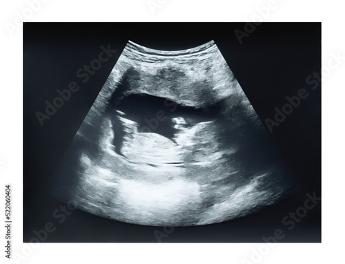 Ultrasound image of fetus in first trimester of singleton pregnancy Fototapet