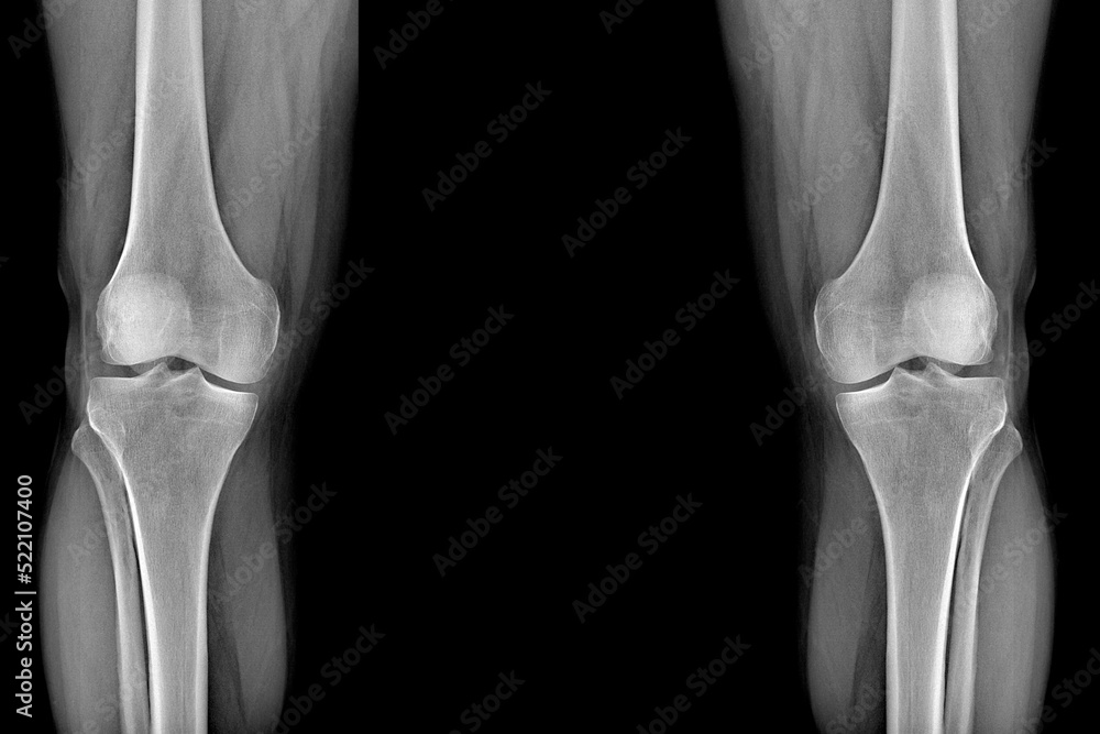 Xray of the knee joints, an image of the knee bones on an Xray. clear picture of the patient