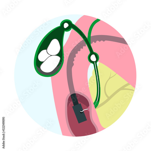 Endoscopic removal of gallbladder stone through mouth, stomach, to bile duct. Closup medical operation infographics.