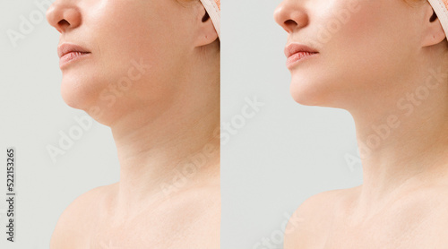 Female double chin before and after correction. Correction of the chin shape liposuction of the neck. The result of the procedure in the clinic of aesthetic medicine. photo