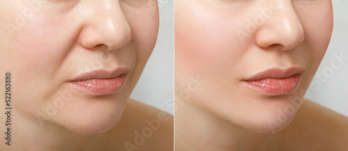 A close portrait of an aged woman before and after the facelift procedure. The result of facial rejuvenation and wrinkle smoothing in a cosmetology clinic.