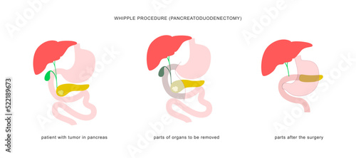 Medical infographic of whipple procedure pancreaticoduodenectomy. Surgery operation in treatment of pancreatic cancer.