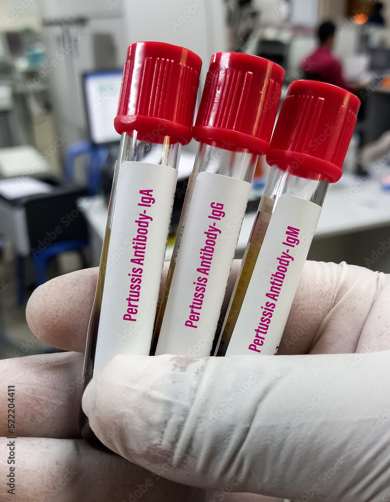 Blood samples for Pertussis antibodies(IgA,IgG,IgM) test to identify