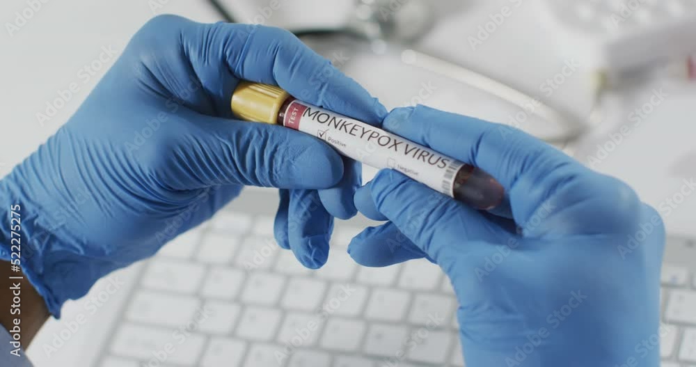 Hands of doctor holding vial with monkeypox virus over keyboard Hands of doctor holding vial with monkeypox virus over keyboard