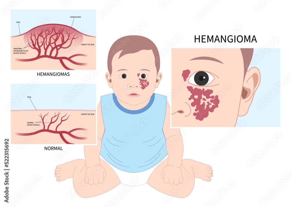 Pigmented birthmarks and Hemangioma on Facial child tumor disorder disease Pigmented birthmarks and Hemangioma on Facial child tumor disorder disease