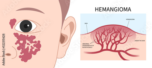 Non cancerous Hemangioma on Facial child tumor disorder disease