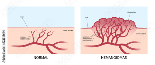 Abnormal of blood vessels or Hemangioma on Facial child tumor disorder disease