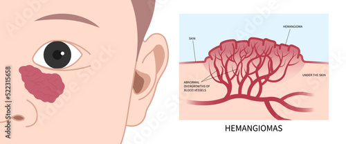Facial child tumor disorder with Hemangioma on disease
