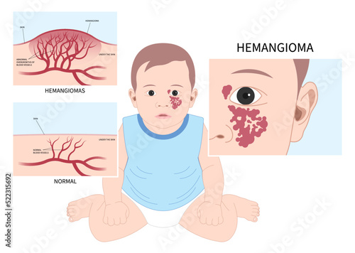 Pigmented birthmarks and Hemangioma on Facial child tumor disorder disease photo