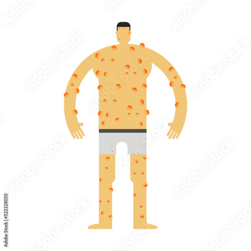 the skin rash lesion of monkeypox virus infection.