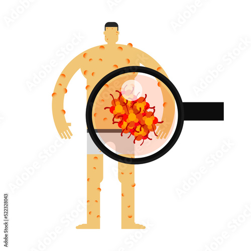 the skin rash lesion of monkeypox virus infection.